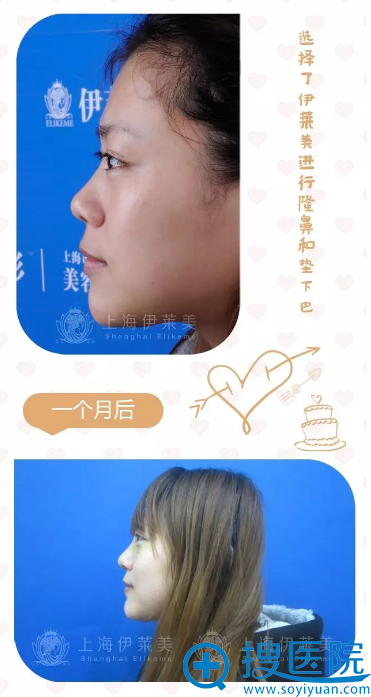 隆鼻+垫下巴术后一个月效果 隆鼻+垫下巴术后一个月效果