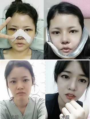 我在韩国巴诺巴奇找吴昌铉院长做面部轮廓+眼鼻整形恢复过程