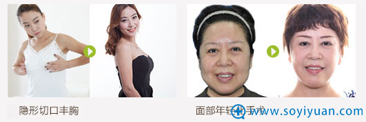 s杭州时光吕敏院长隆胸+面部年轻化案例 s杭州时光吕敏院长隆胸+面部年轻化案例