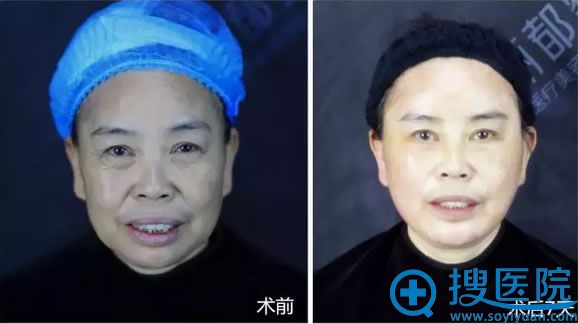 方阿姨术前术后对比,明显变得年轻不少 方阿姨术前术后对比,明显变得年轻不少