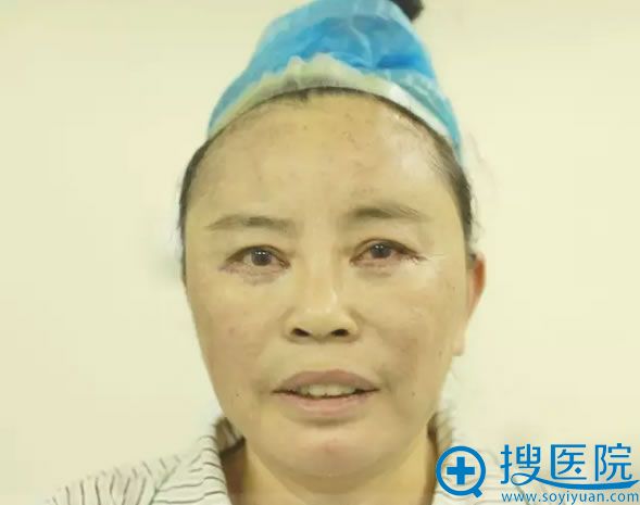自体脂肪面部填充+4D美羽线雕+祛眼袋术后即刻 自体脂肪面部填充+4D美羽线雕+祛眼袋术后即刻
