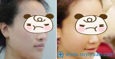 自体脂肪丰苹果肌前后对比图 自体脂肪丰苹果肌前后对比图