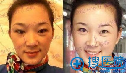 自体脂肪面部填充前后对比效果 自体脂肪面部填充前后对比效果
