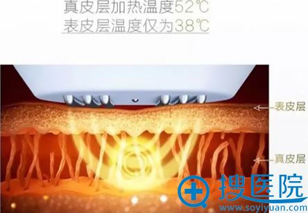 射频除皱原理介绍 射频除皱原理介绍