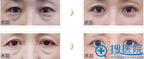 去眼袋前后对比案例_董红星医生 去眼袋前后对比案例_董红星医生