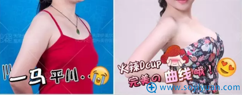 产后胸部下垂的我找天津伊美尔熊斌做完假体隆胸后重获自信
