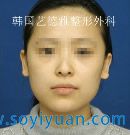 两颚手术对比案例