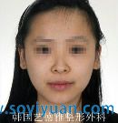 两颚手术对比案例