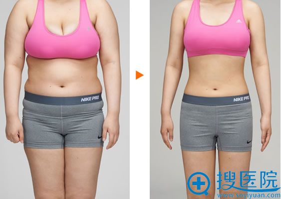 上海美莱吸脂瘦身前后对比案例 上海美莱吸脂瘦身前后对比案例