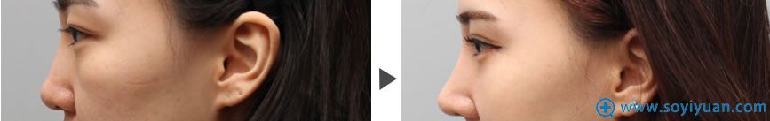 上海美莱假体隆鼻术后效果 上海美莱假体隆鼻术后效果