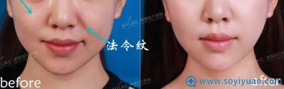 <!--<i data=20240710 data-id=13583></i>-->玻尿酸祛法令纹丰苹果肌效果 <!--<i data=20240710 data-id=13583></i>-->玻尿酸祛法令纹丰苹果肌效果