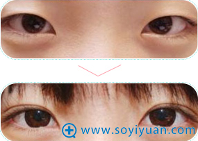 <!--<i data=20240710 data-id=13583></i>-->双眼皮手术前后对比 <!--<i data=20240710 data-id=13583></i>-->双眼皮手术前后对比