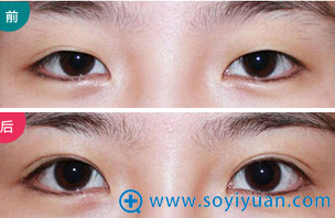 <!--<i data=20240710 data-id=12678></i>-->双眼皮前后对比图 <!--<i data=20240710 data-id=12678></i>-->双眼皮前后对比图