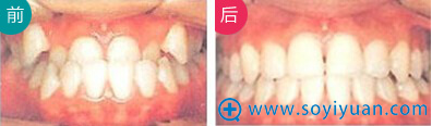 <!--<i data=20240710 data-id=12678></i>-->传统矫正案例图 <!--<i data=20240710 data-id=12678></i>-->传统矫正案例图