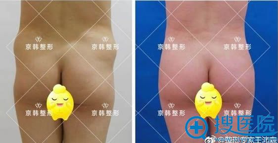 王沛森教授吸脂失败修复案例 王沛森教授吸脂失败修复案例