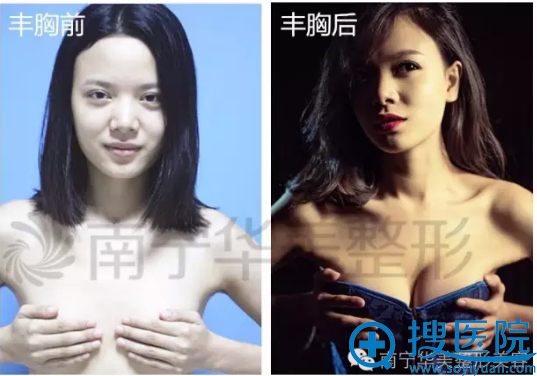 南宁华美整形医院假体丰胸前后对比案例 南宁华美整形医院假体丰胸前后对比案例