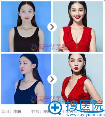 南宁华美蜜桃胸前后对比案例 南宁华美蜜桃胸前后对比案例