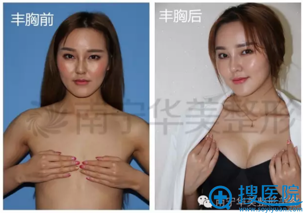 南宁华美假体丰胸前后对比图 南宁华美假体丰胸前后对比图