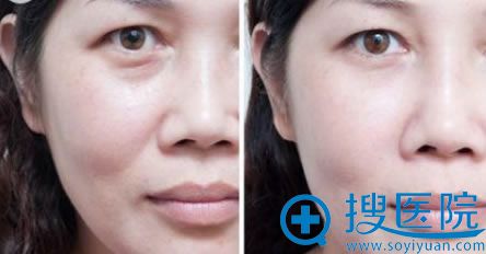 武汉新至美眼部除皱前后效果对比照片 武汉新至美眼部除皱前后效果对比照片