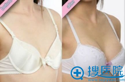 假体隆胸案例图_武汉新至美 假体隆胸案例图_武汉新至美