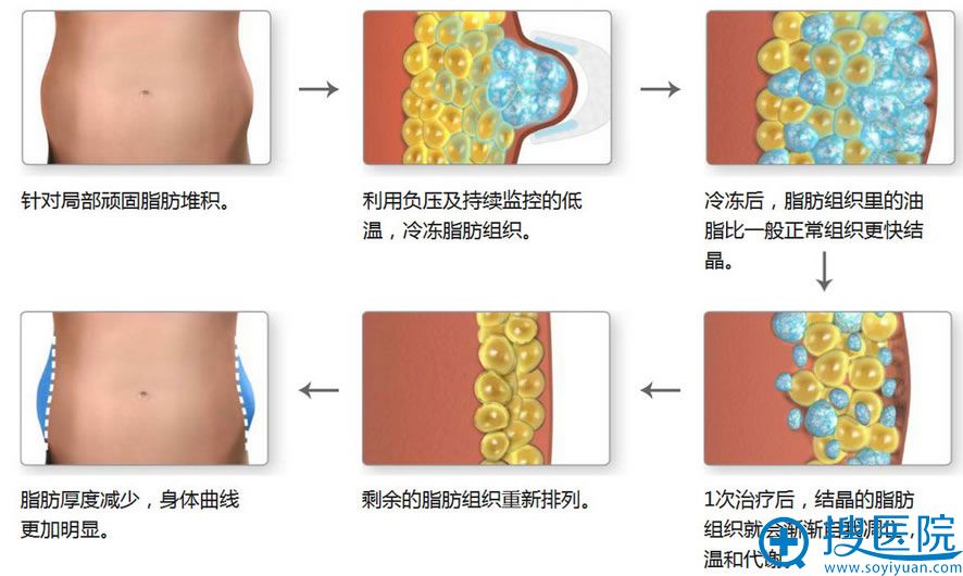 酷塑(冰美人)瘦身原理 酷塑(冰美人)瘦身原理