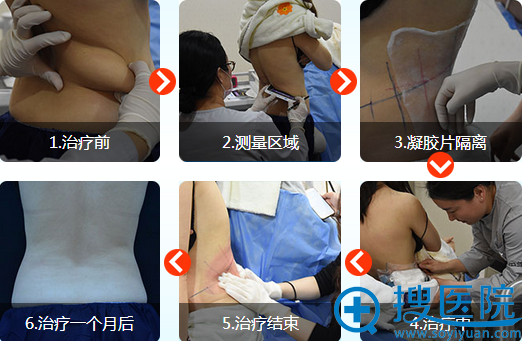 酷塑治疗过程详细步骤 酷塑治疗过程详细步骤