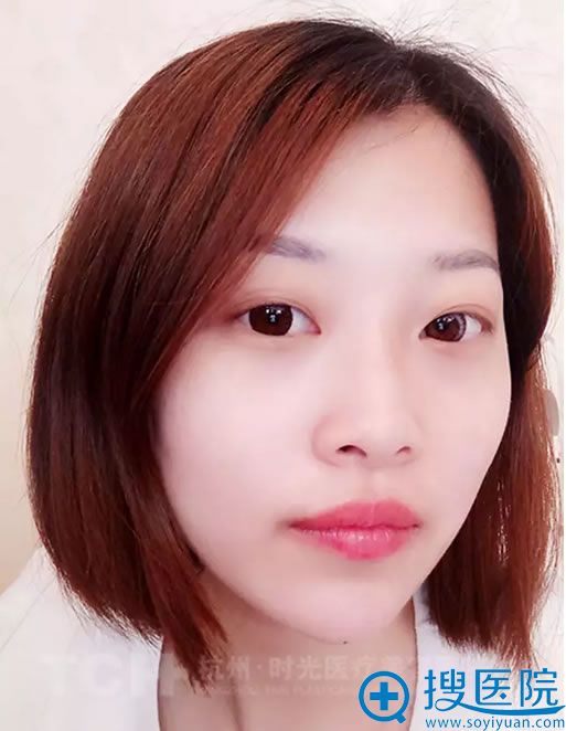 玻尿酸隆鼻丰下巴一周后效果 玻尿酸隆鼻丰下巴一周后效果