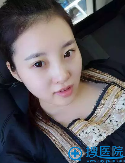 割双眼皮之前的我 割双眼皮之前的我