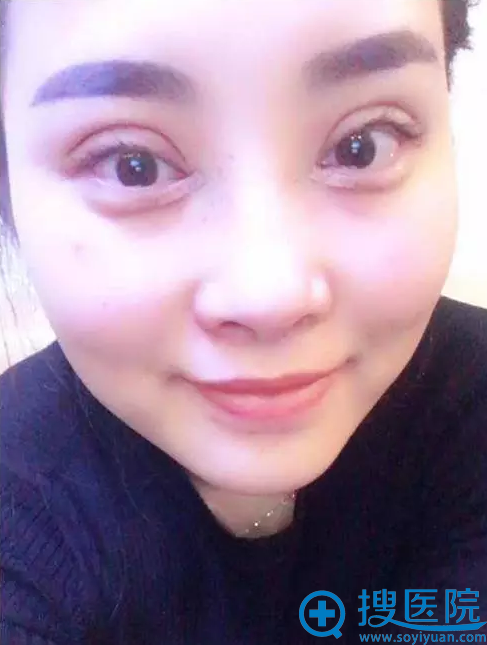 刚做完双眼皮天,期待 刚做完双眼皮天,期待