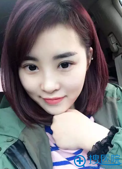 现在的我,双眼皮恢复的超自然 现在的我,双眼皮恢复的超自然