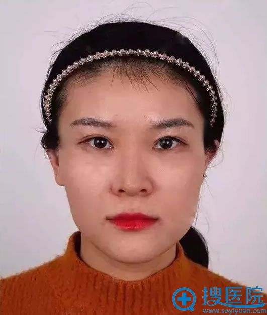 【视频案例】太原时光自体脂肪填充太阳穴丰苹果肌术后恢复照片