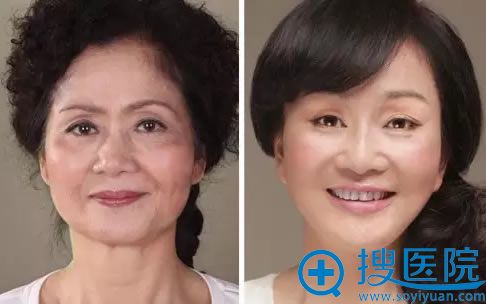 贵阳华美整形医院线雕效果对比 贵阳华美整形医院线雕效果对比