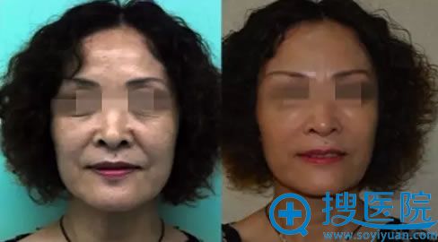 乔雅登玻尿酸案例对比_贵阳华美 乔雅登玻尿酸案例对比_贵阳华美