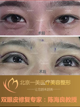 北京一美整形陈海良教授怎么样 双眼皮修复案例见证实力