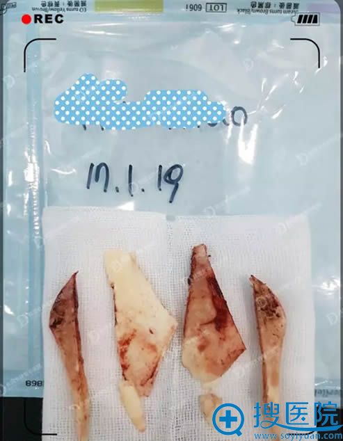 韩国女神整形医院为我做下巴整形+下颌角整形切除的骨头 韩国女神整形医院为我做下巴整形+下颌角整形切除的骨头