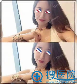 韩国女神假体垫下巴+下颌角整形术后5个月美照 韩国女神假体垫下巴+下颌角整形术后5个月美照