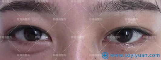 找陈海良教授做双眼皮修复术前照 找陈海良教授做双眼皮修复术前照