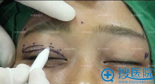 陈海良教授在为我设定双眼皮修复方案 陈海良教授在为我设定双眼皮修复方案