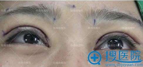 在<!--<i data=20240710 data-id=7737></i>-->整形找陈海良教授做双眼皮修复术后照 在<!--<i data=20240710 data-id=7737></i>-->整形找陈海良教授做双眼皮修复术后照