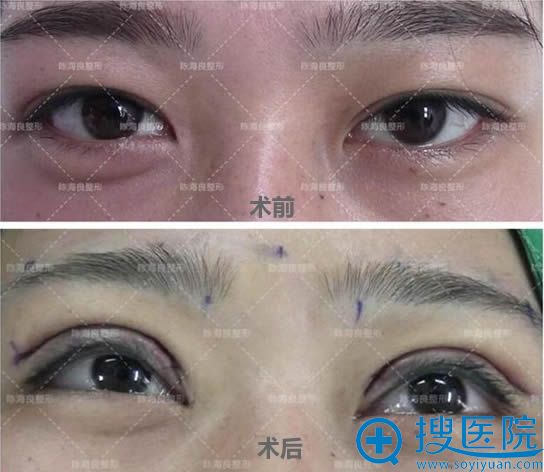 陈海良教授双眼皮修复案例对比图 陈海良教授双眼皮修复案例对比图