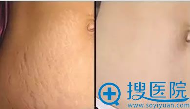 蜂巢皮秒祛妊娠纹术后对比效果 蜂巢皮秒祛妊娠纹术后对比效果