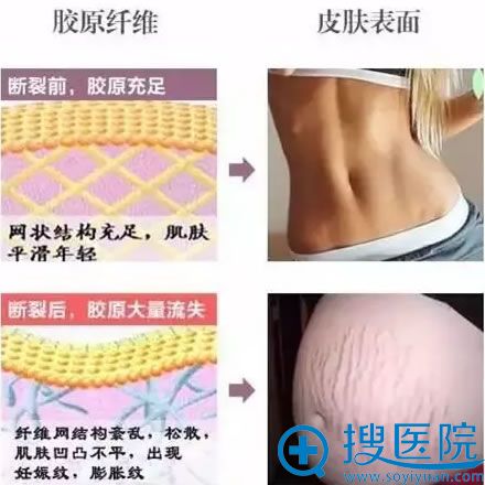 妊娠纹是如何产生的 妊娠纹是如何产生的