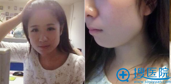 上海华美李志海磨骨怎么样 花3万多元做下颌角真实经历告诉你