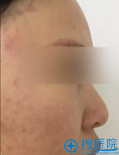 谭拯鼻头修复案例 谭拯鼻头修复案例