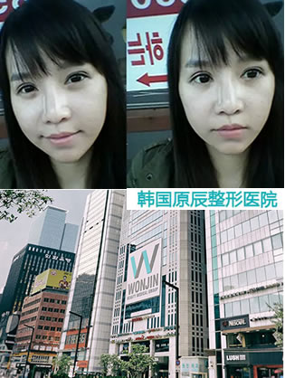 韩国原辰整形怎么样 面部轮廓整形案例来为您揭晓 效果见证实力
