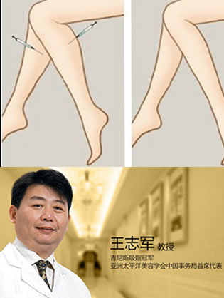 吸脂和瘦脸除皱瘦小腿哪种效果好?看吸脂医生王志军教授怎么说