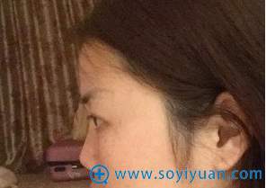 【案例】看我花1.8万元找上海百达丽谈宇腾做的隆鼻效果怎么样