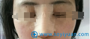 术后第四天正面照,鼻子很肿 术后第四天正面照,鼻子很肿