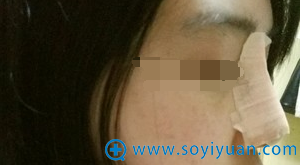 硅胶隆鼻第4天,侧面照 硅胶隆鼻第4天,侧面照