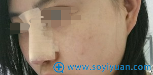 硅胶隆鼻术后即刻侧面照 硅胶隆鼻术后即刻侧面照